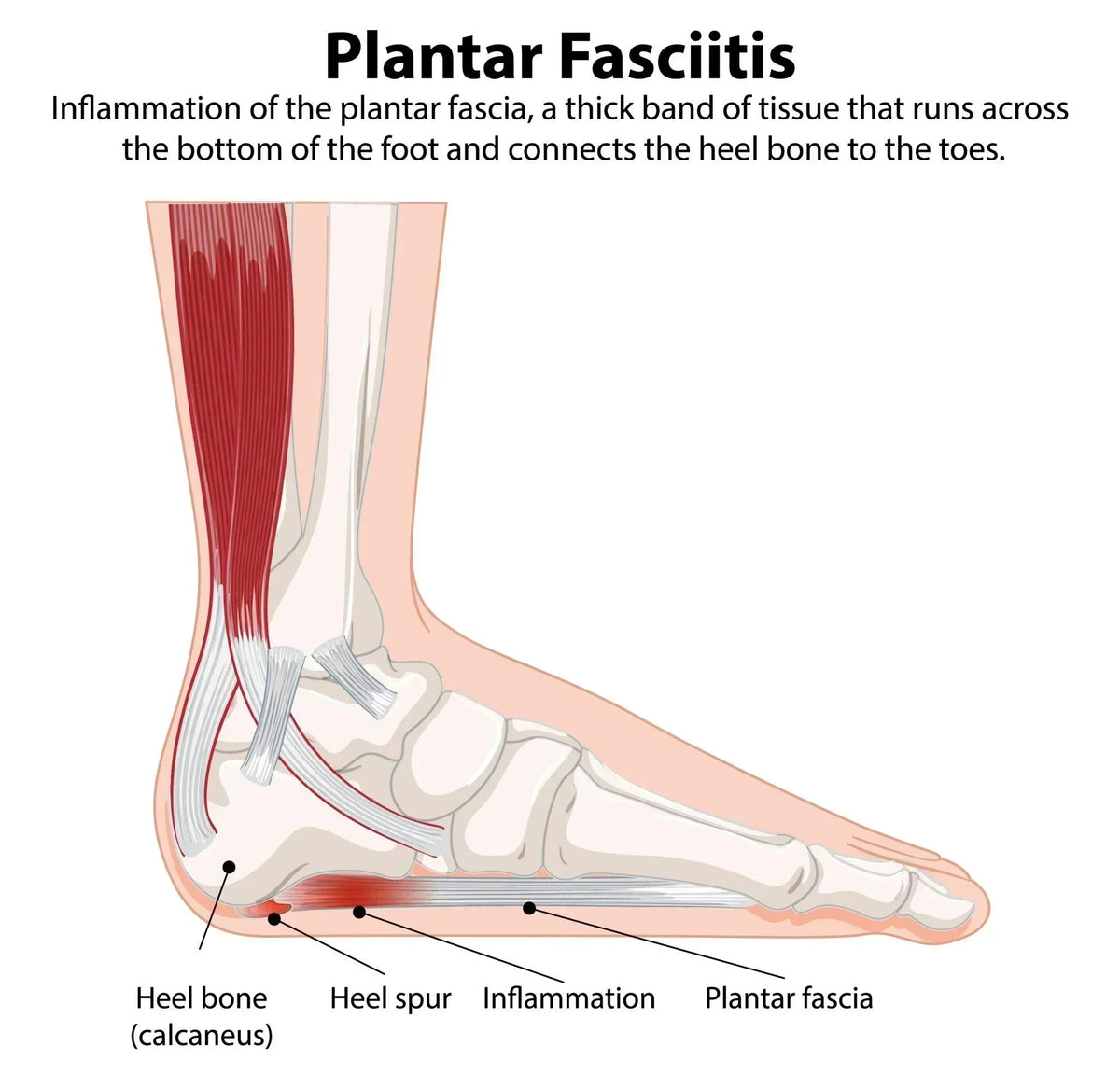 Plantar fasciitis foot pain diagram showing heel and arch inflammation